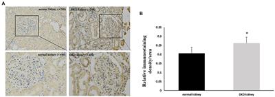 Induction of Pyroptosis in Renal Tubular Epithelial Cells Using High Glucose